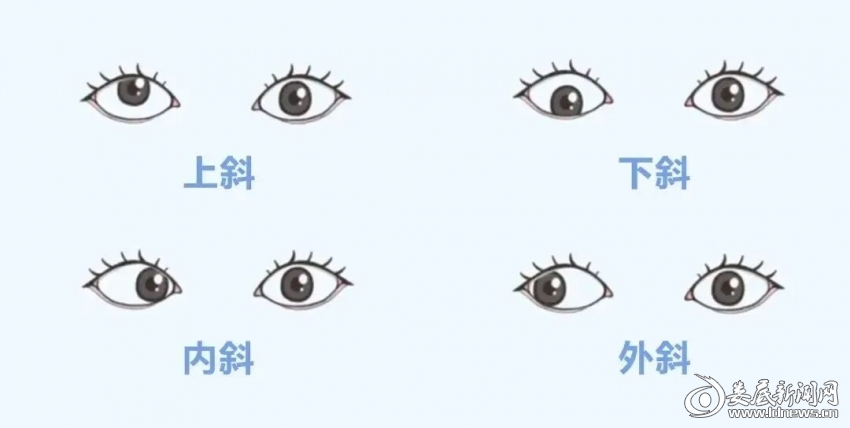 ▲斜视是什么？